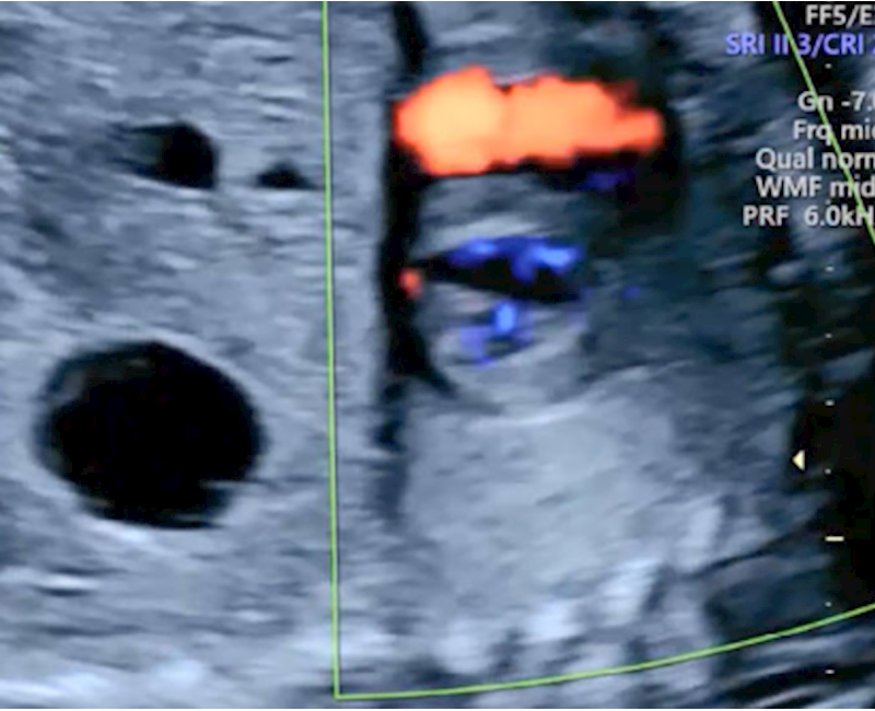 Atrioventricular septal defect: An extended approach to prenatal sonographic imaging of the atrioventricular valves